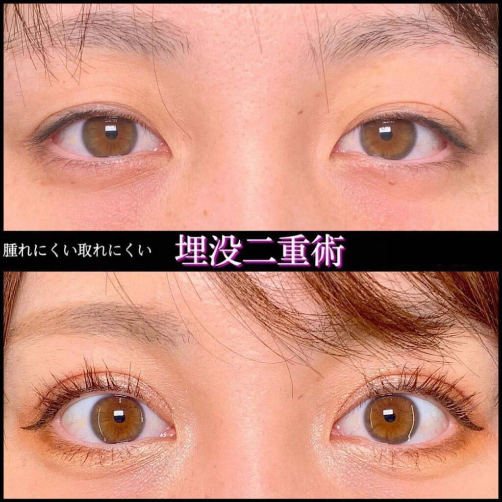 埋没法の症例 (15)