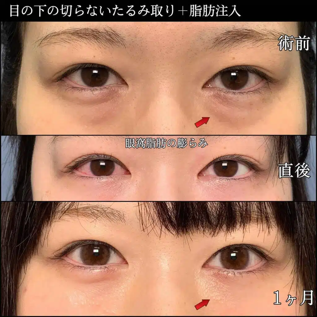 たるみ取り 脂肪注入