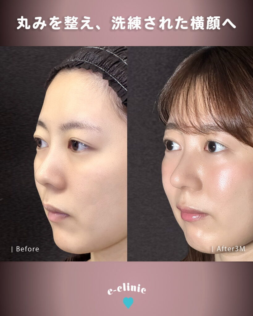 鼻尖形成3D法と鼻尖軟骨移植と鼻柱下降の症例写真