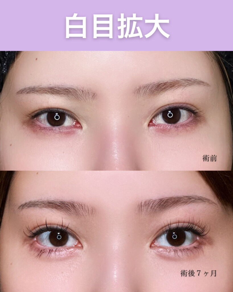 目尻切開とタレ目形成の症例写真