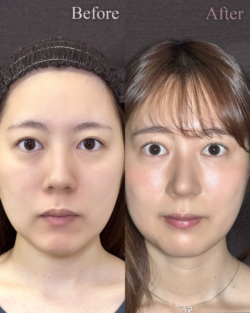 鼻尖形成3D法と鼻尖軟骨移植と鼻柱下降の症例写真 (2)