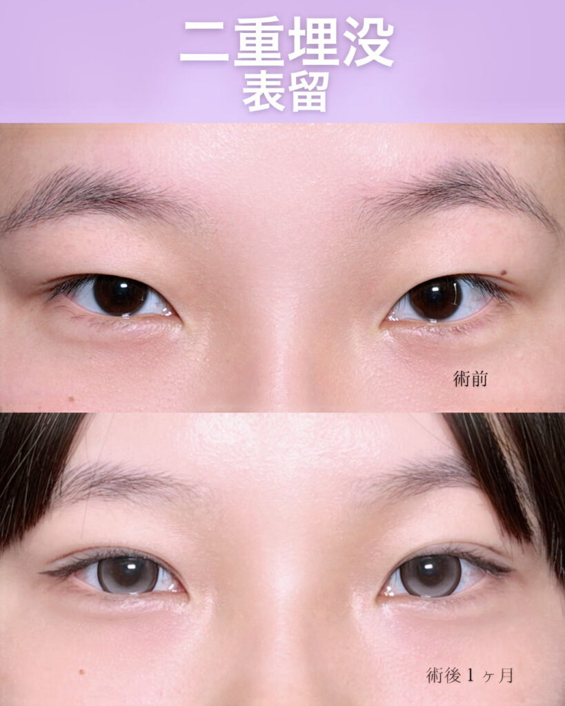 埋没法の症例写真