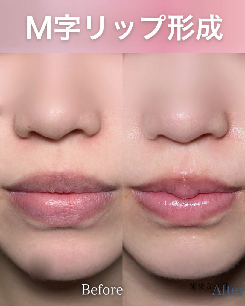 M字リップ形成の症例写真