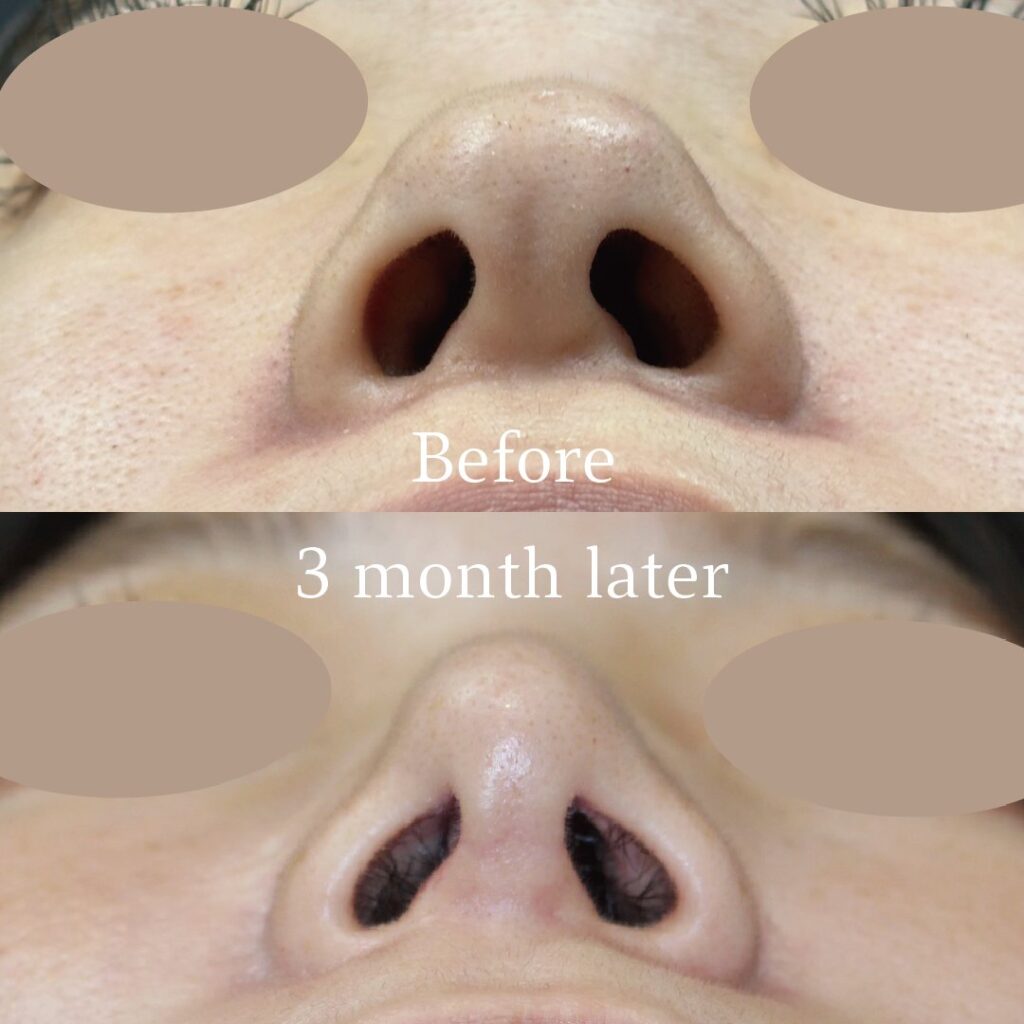 鼻尖形成3D法と耳軟骨移植とプロテーゼの３か月後の症例