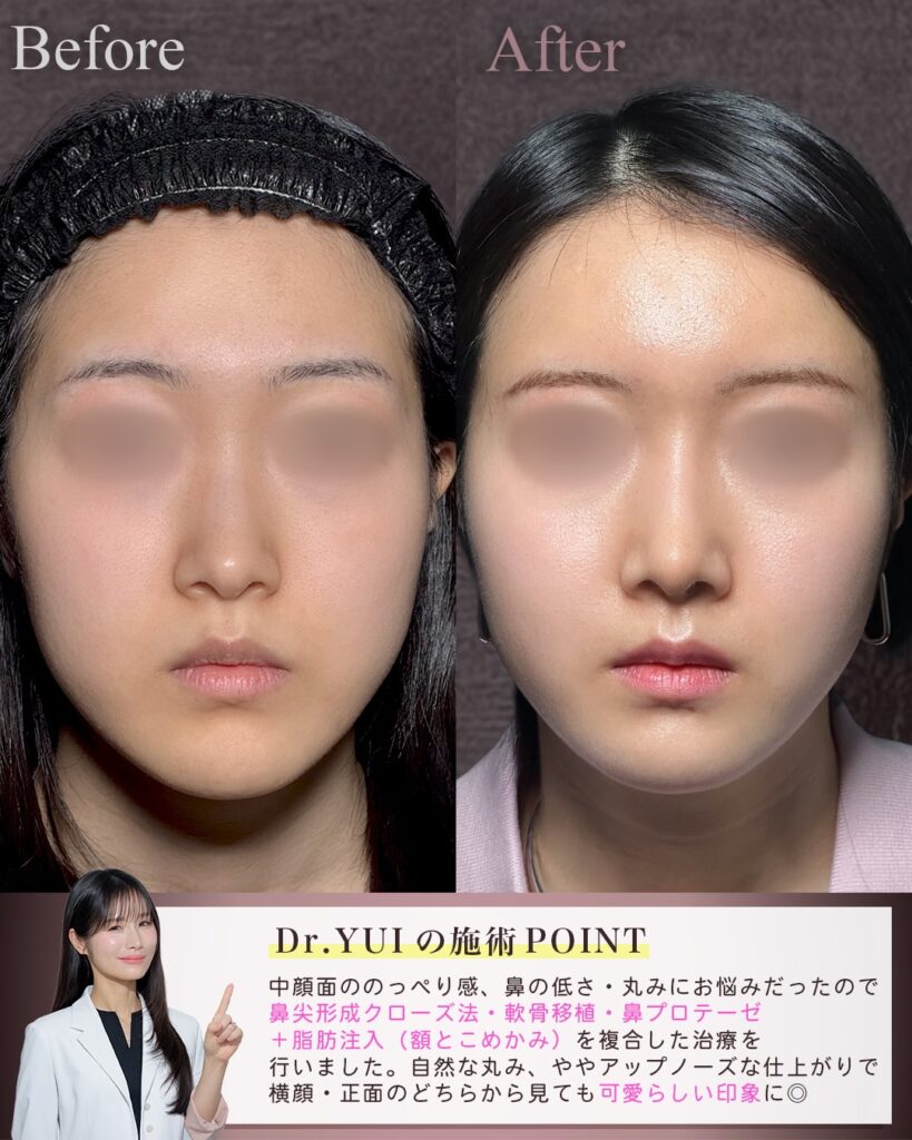 鼻尖形成クローズ法と鼻尖軟骨移植と鼻プロテーゼと脂肪注入（額／こめかみ）の症例写真 (2)