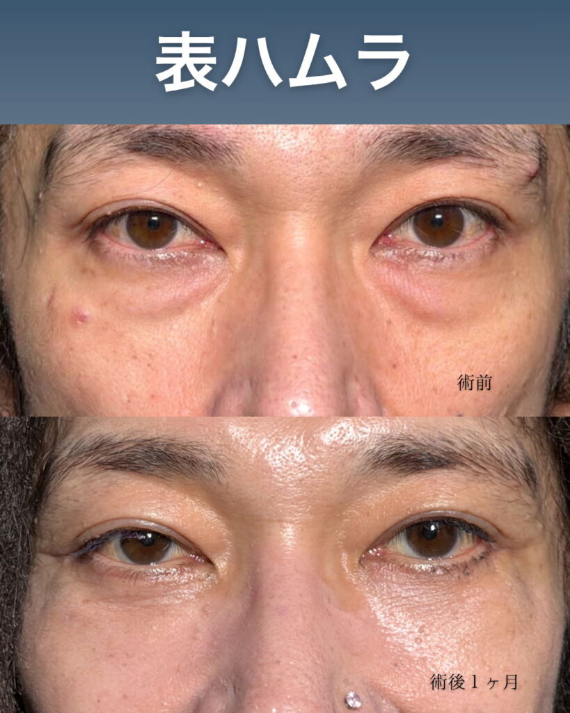 裏ハムラ法の症例写真 (2)