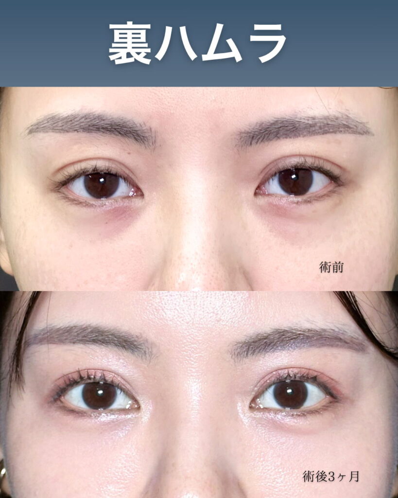 裏ハムラ法の症例写真 (3)