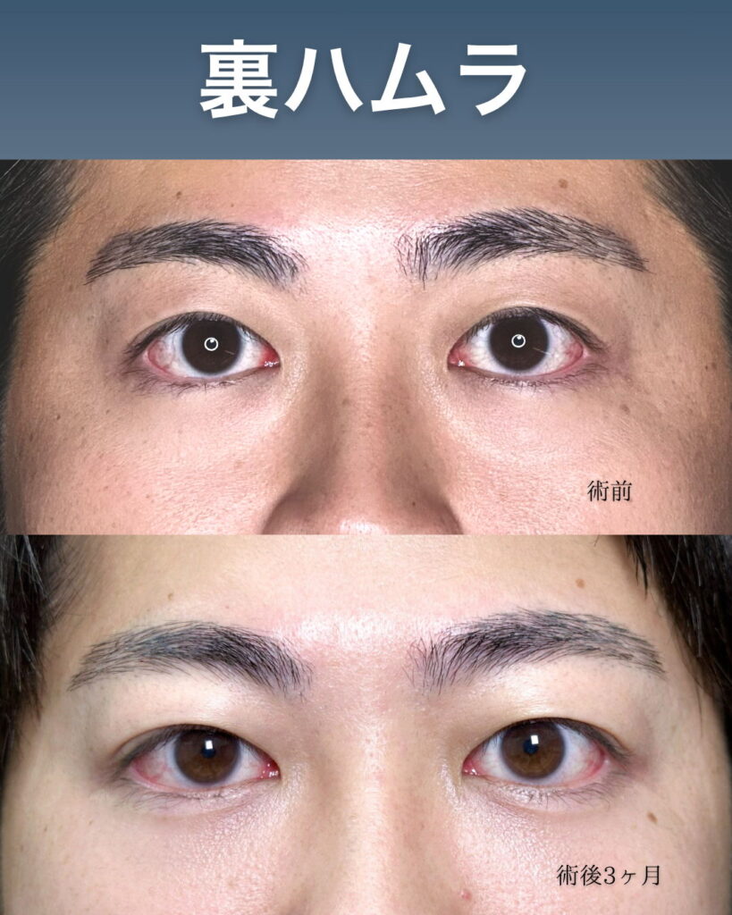 裏ハムラ法の症例写真 (1)