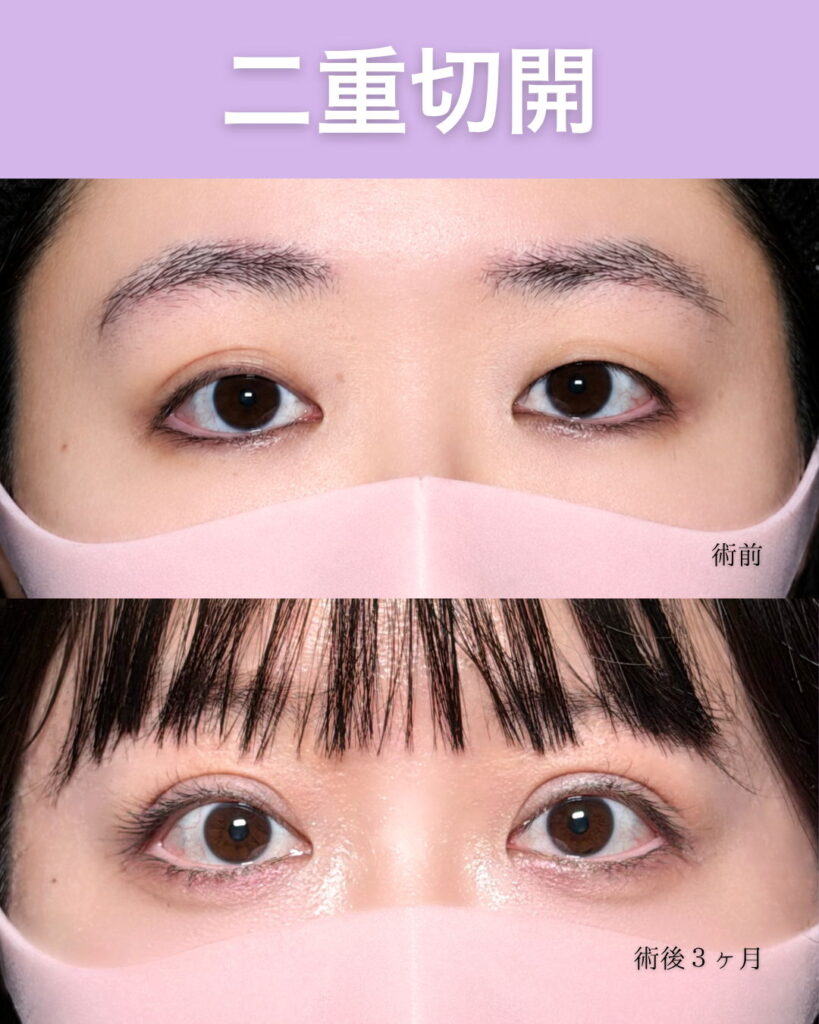 たるみ取り併用全切開の症例写真