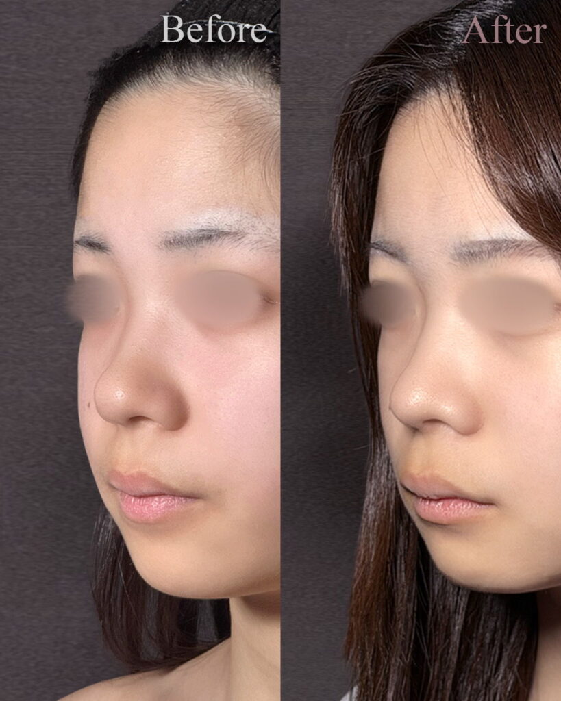 鼻尖形成と軟骨移植と小鼻縮小の症例写真