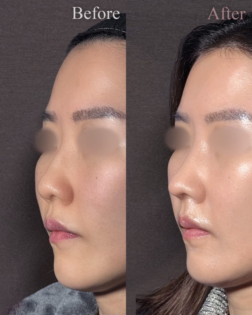 鼻尖形成3D法と軟骨移植の症例写真