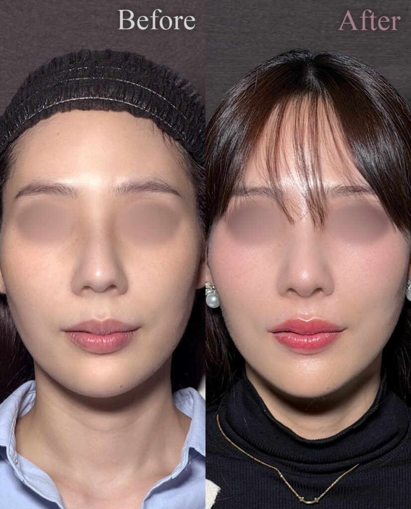 鼻尖形成3D法と軟骨移植と鼻柱下降の症例写真
