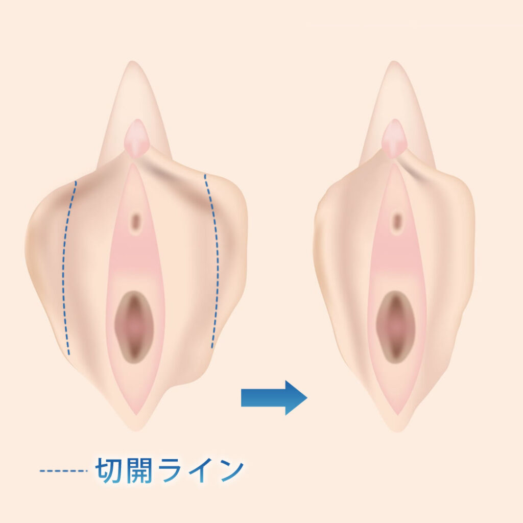 小陰唇縮小手術の図解