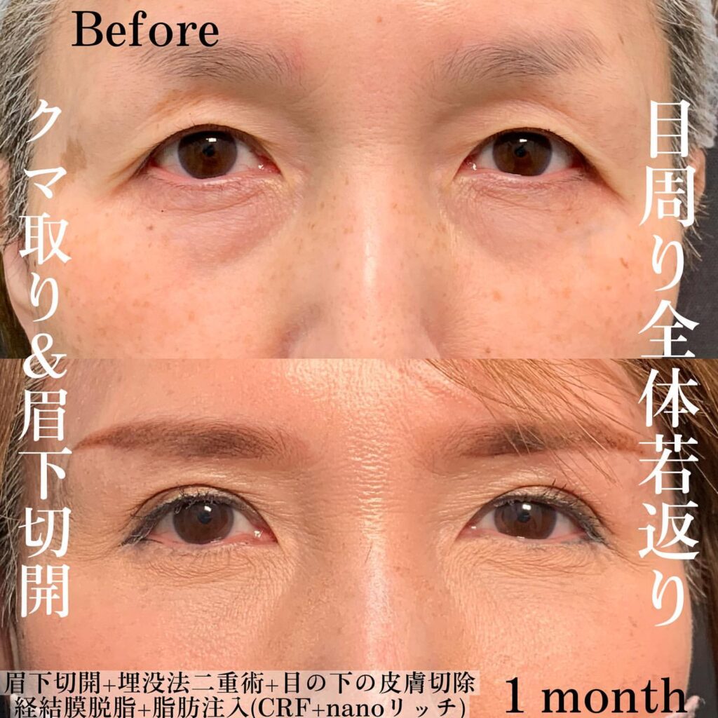 eクリニック横浜みなとみらい院の経血膜脱脂の症例写真（4）