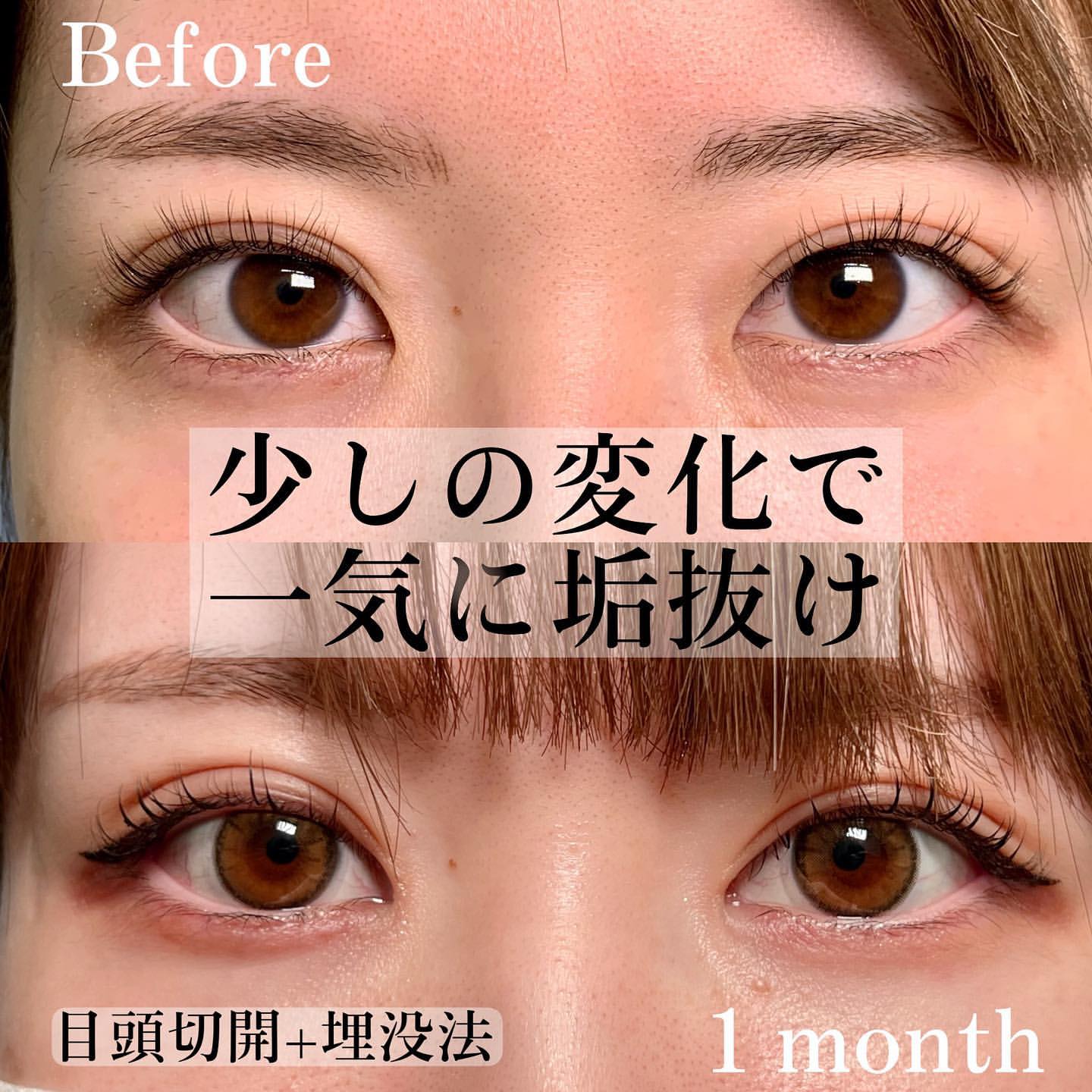 目頭切開と埋没法の症例写真