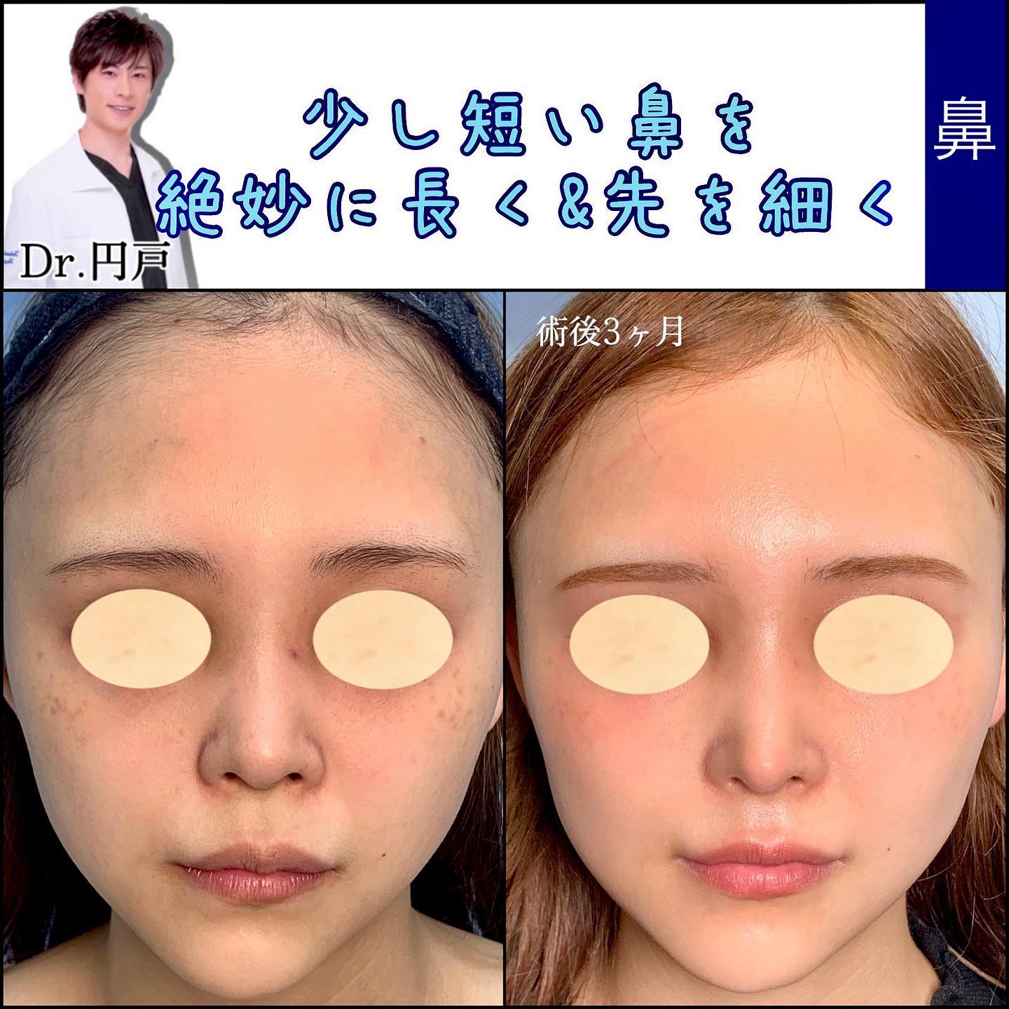 鼻中隔延長と軟骨移植と鼻尖形成を同時に行った３か月後の症例写真