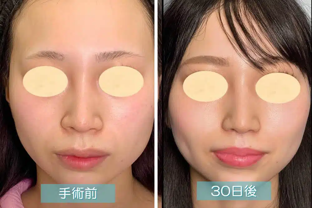 小鼻縮小
