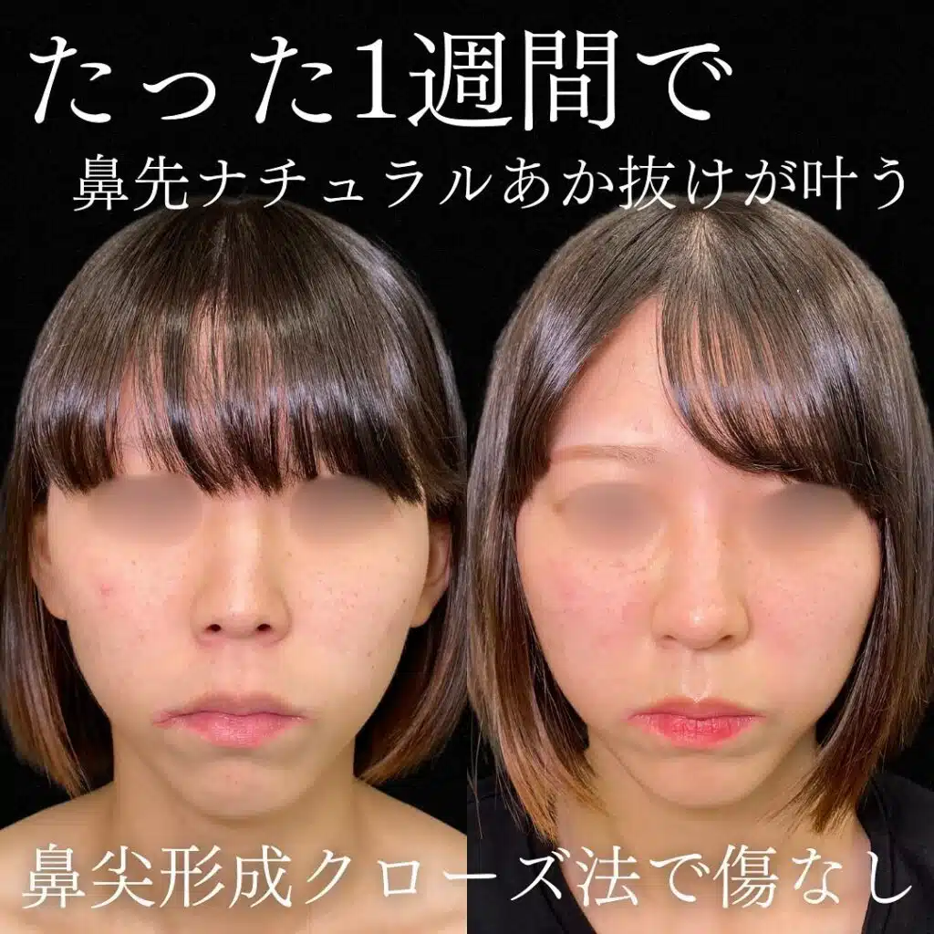鼻尖形成クローズ法