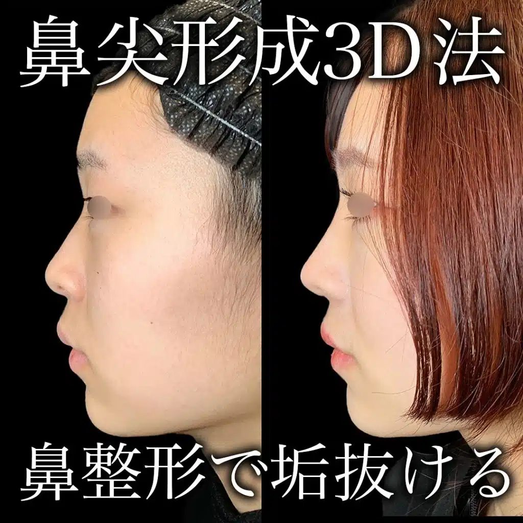 鼻尖形成3D法
