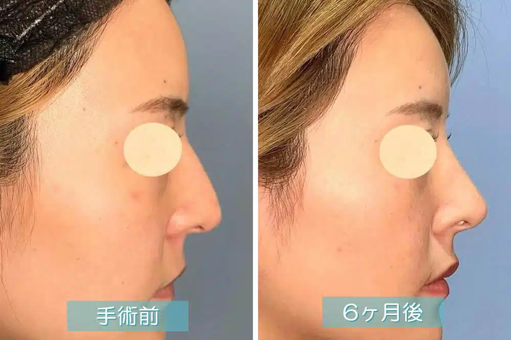 わし鼻修正(ハンプ修正)