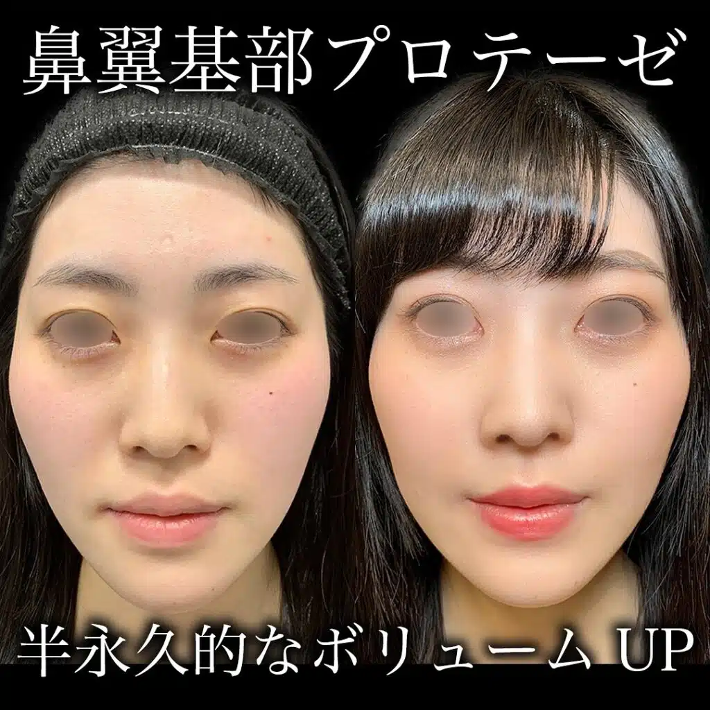 鼻翼基部プロテーゼ