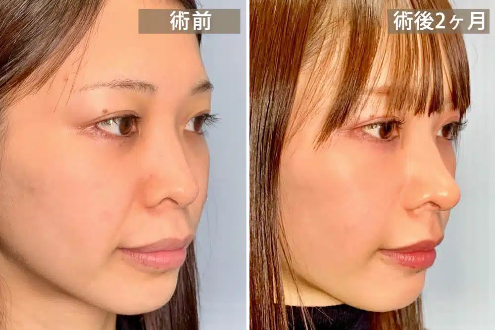 耳軟骨移植
