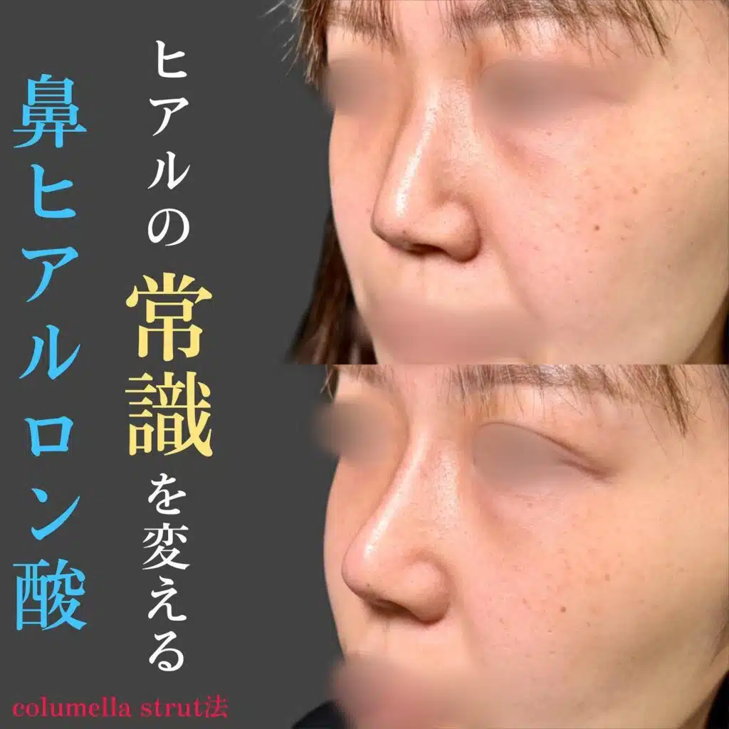 鼻へのヒアルロン酸注入