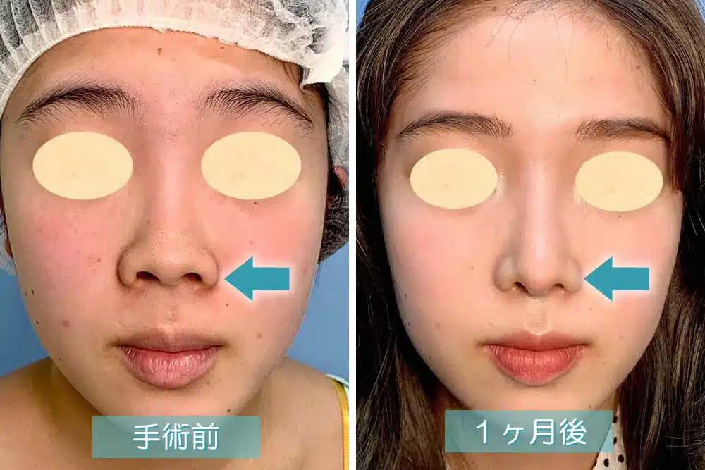 鼻尖形成