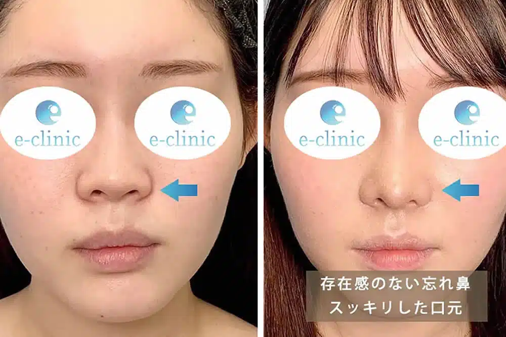 ほうれい線(⿐翼)基部プロテーゼ・人工真皮 |貴族手術