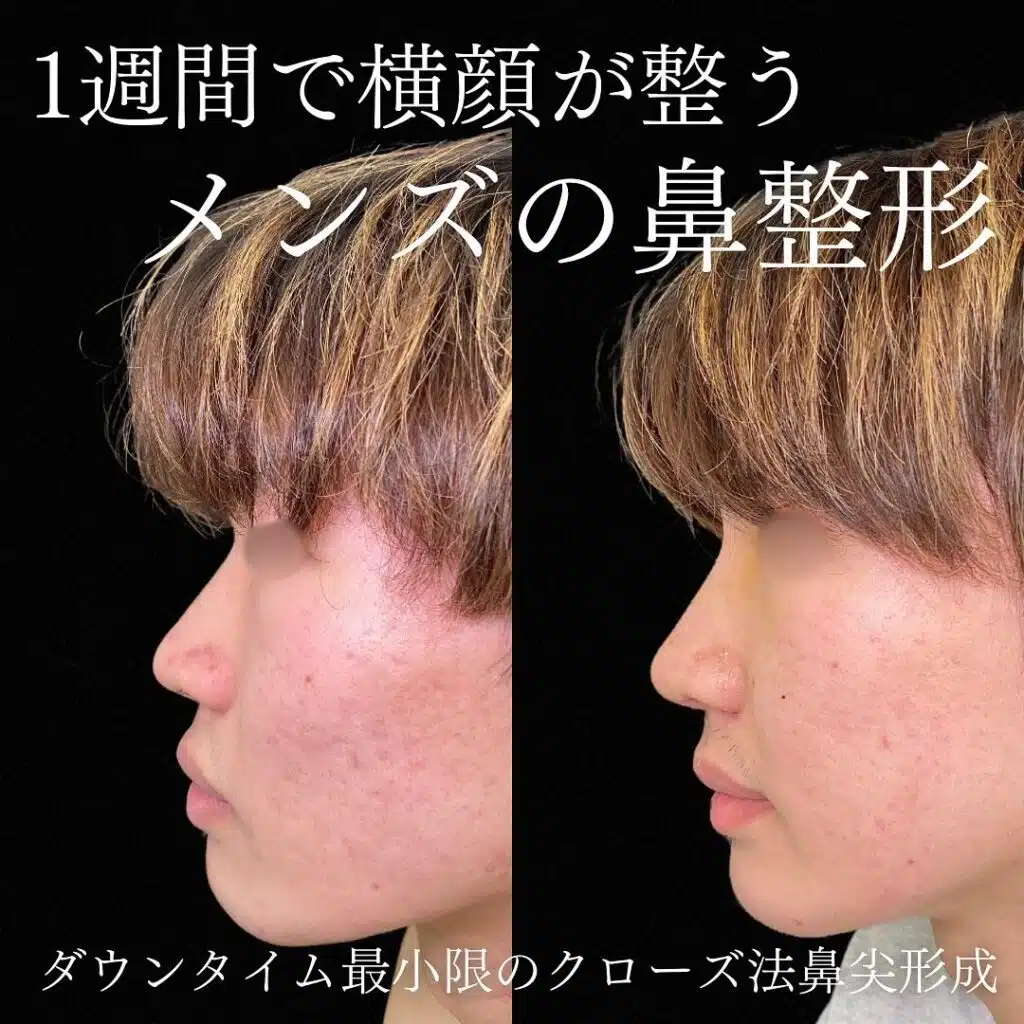 メンズ クローズ鼻尖形成