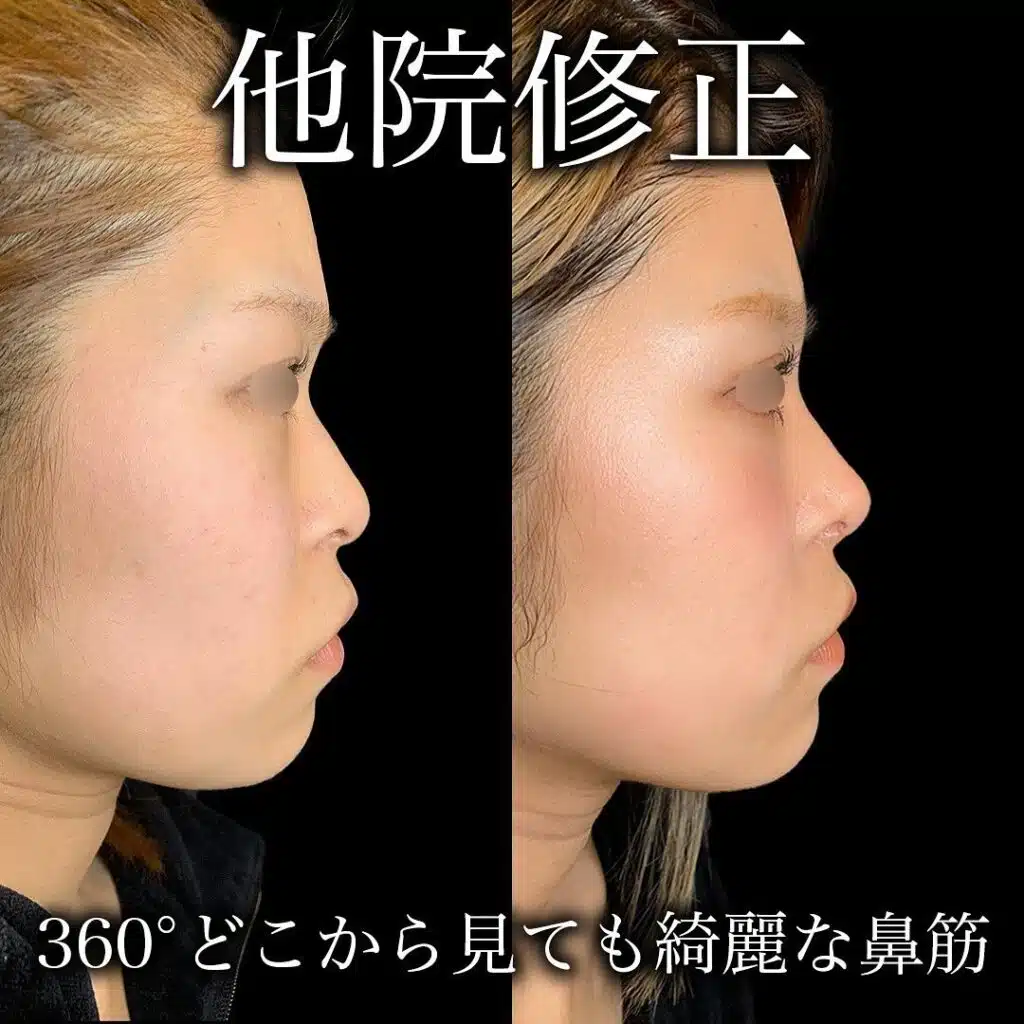 鼻 他院修正