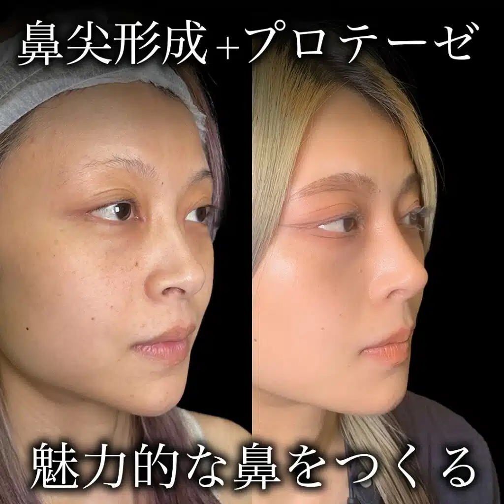 鼻尖形成 プロテーゼ