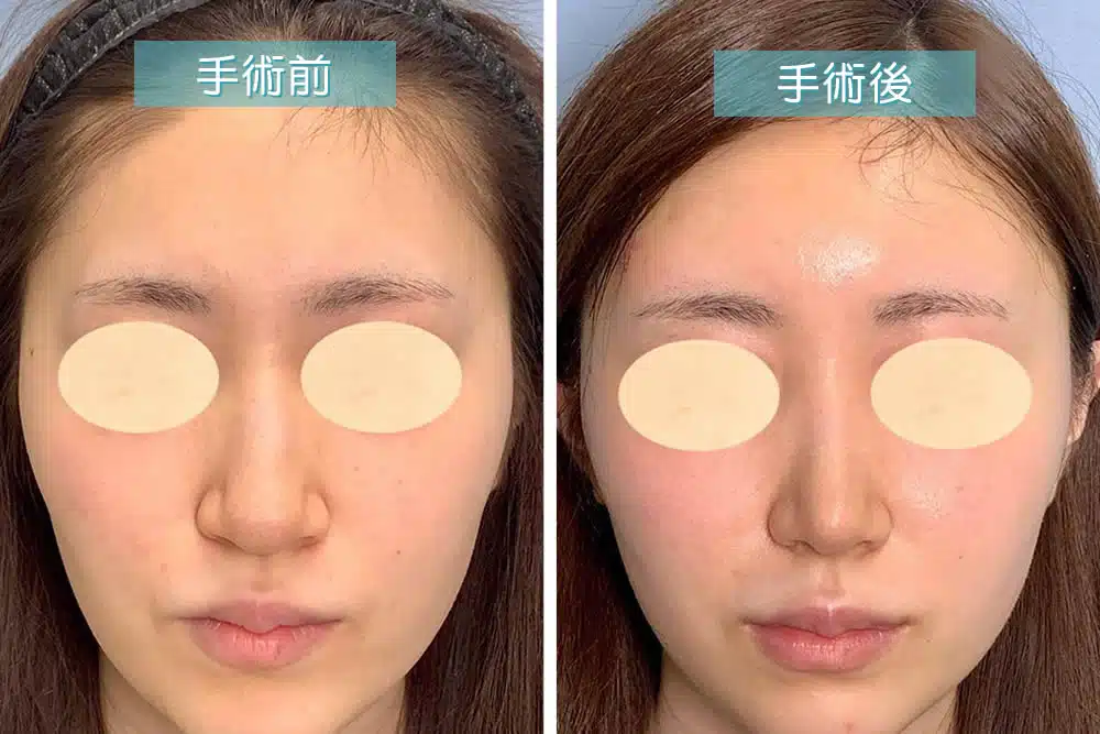 鼻中隔延長