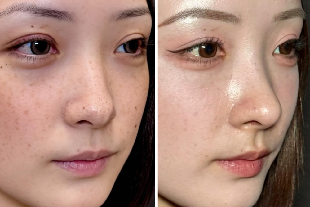 閉鎖式鼻中隔延長の症例写真