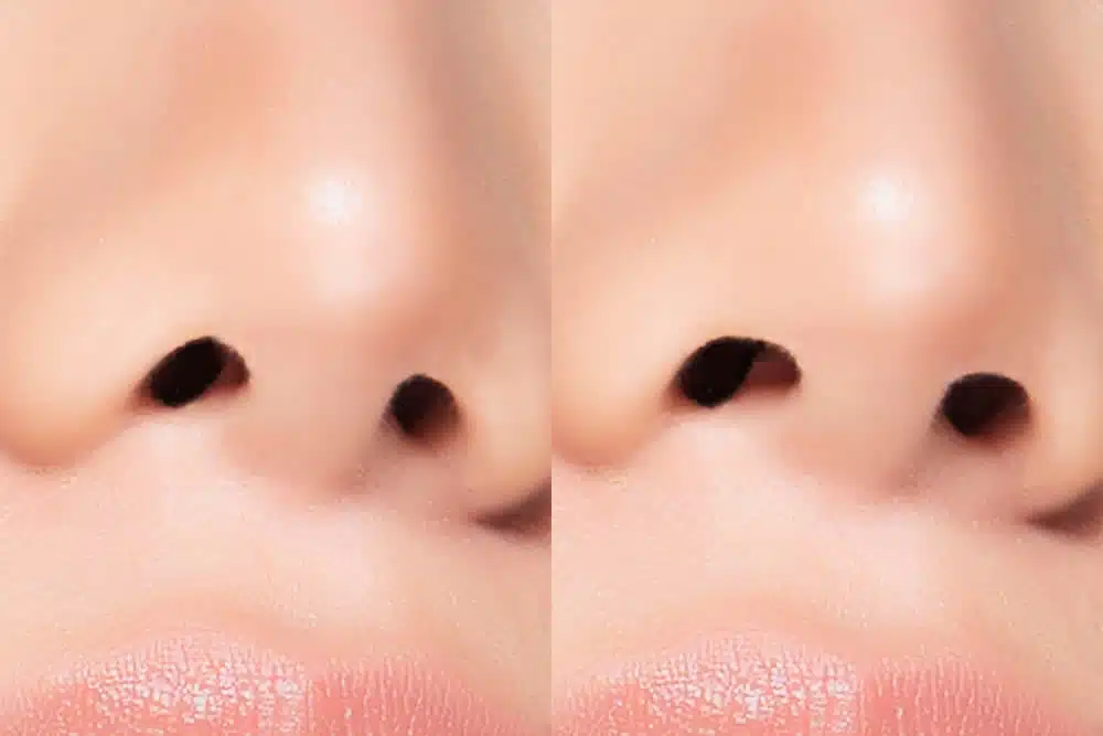 鼻孔縁挙上術