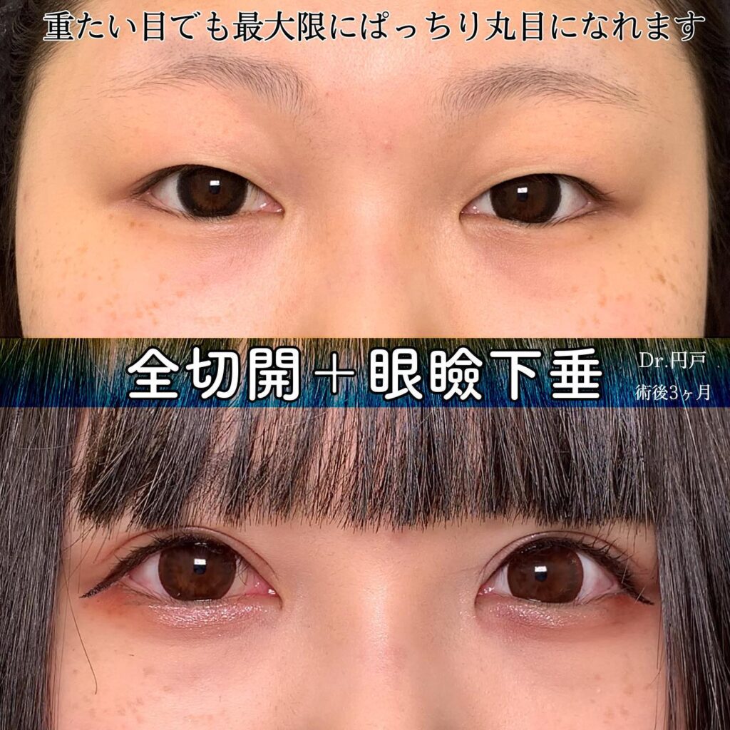 全切開と眼瞼下垂を同時に行った症例写真