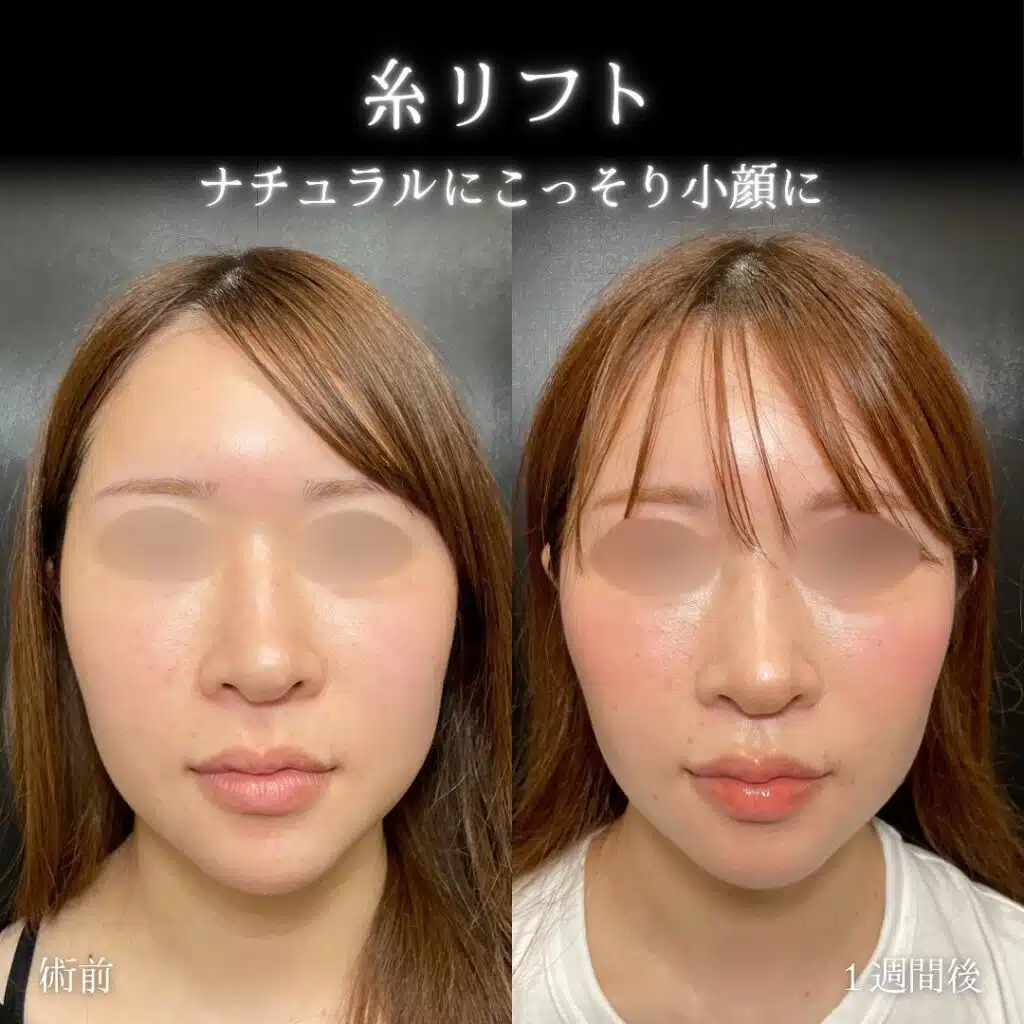 糸リフト