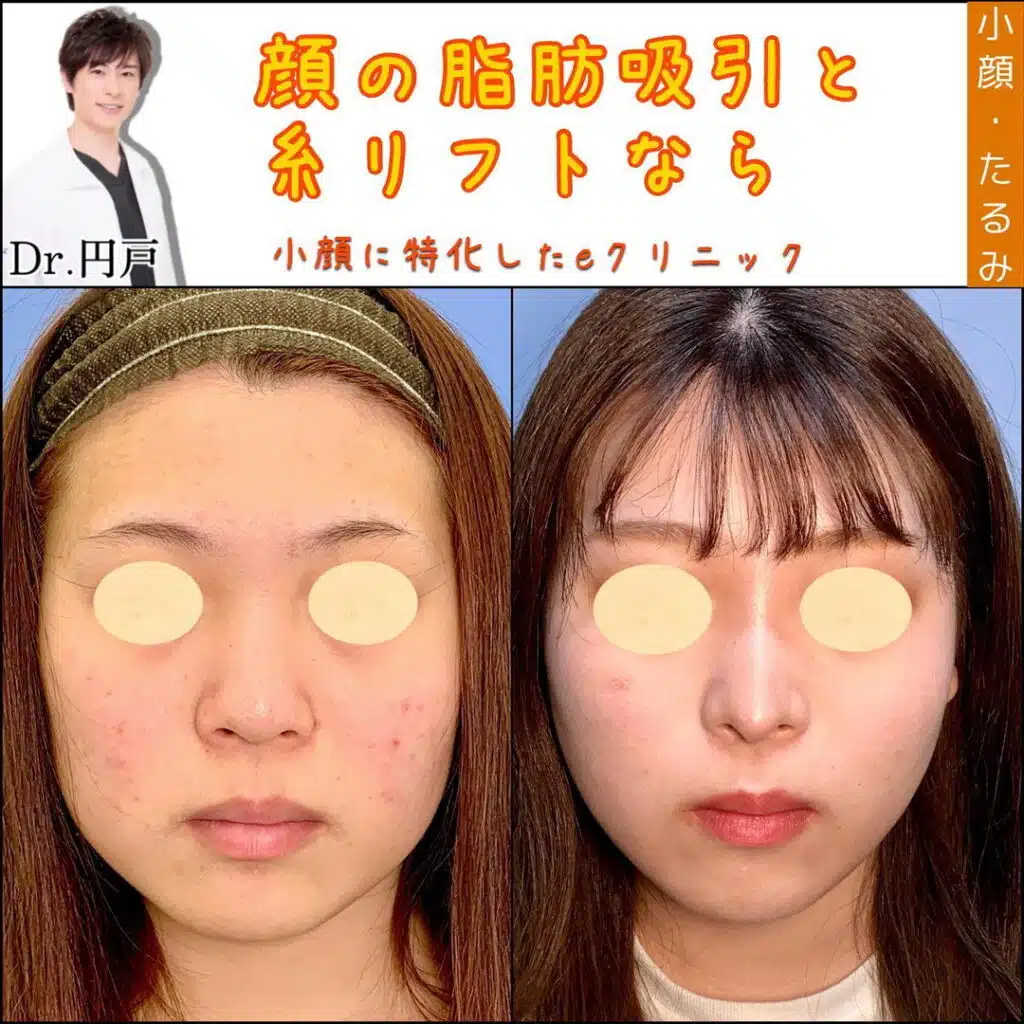 脂肪吸引 糸リフト