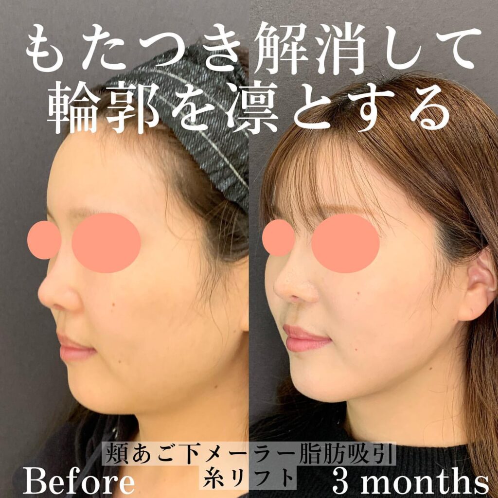 eclinic横浜みなとみらい院の糸リフト症例写真