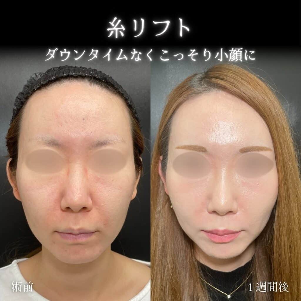 eclinic横浜みなとみらい院の糸リフト症例写真
