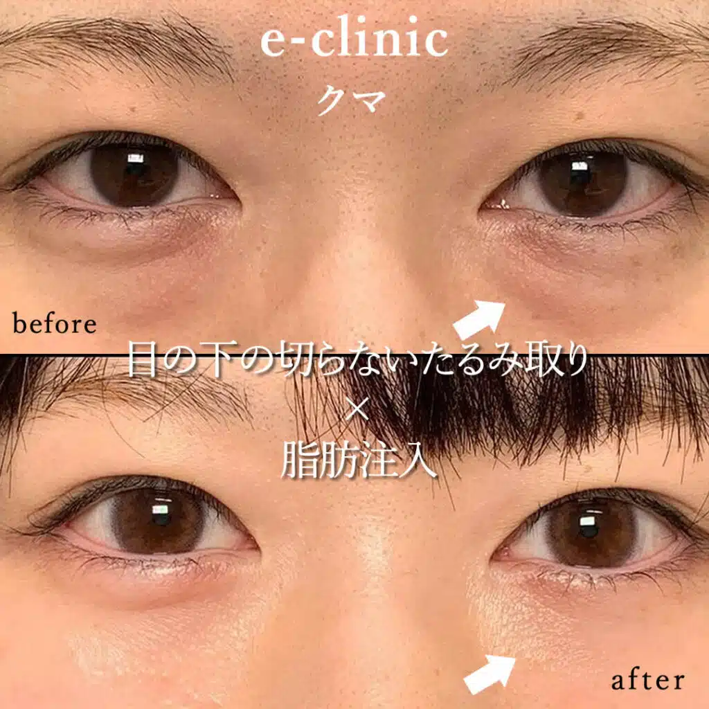 eclinic横浜みなとみらい院の表ハムラの症例画像(1)