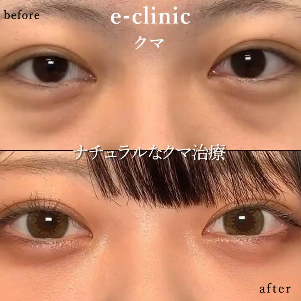 eclinic横浜みなとみらい院の表ハムラの症例画像(2)