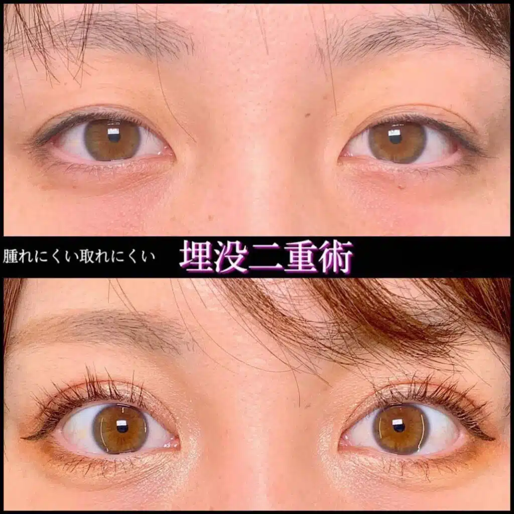 腫れにくい取れにくい　埋没二重術　横浜みなとみらい