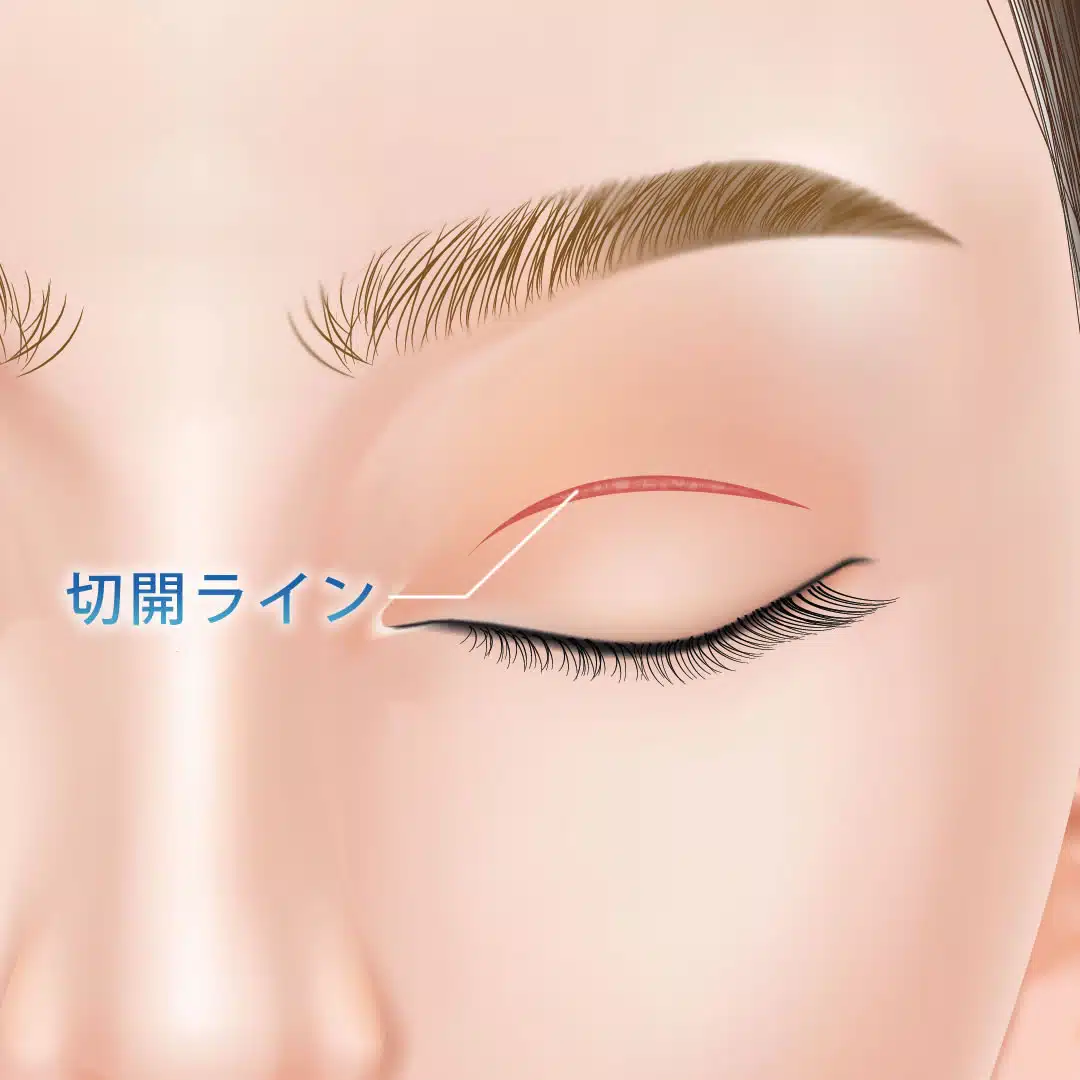 二重全切開　横浜みなとみらい