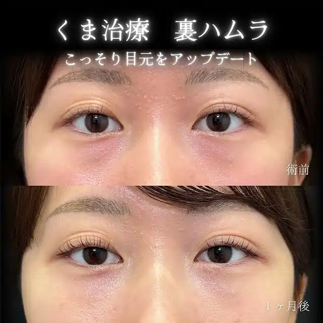 クマ取り　裏ハムラ法　横浜みなとみらい