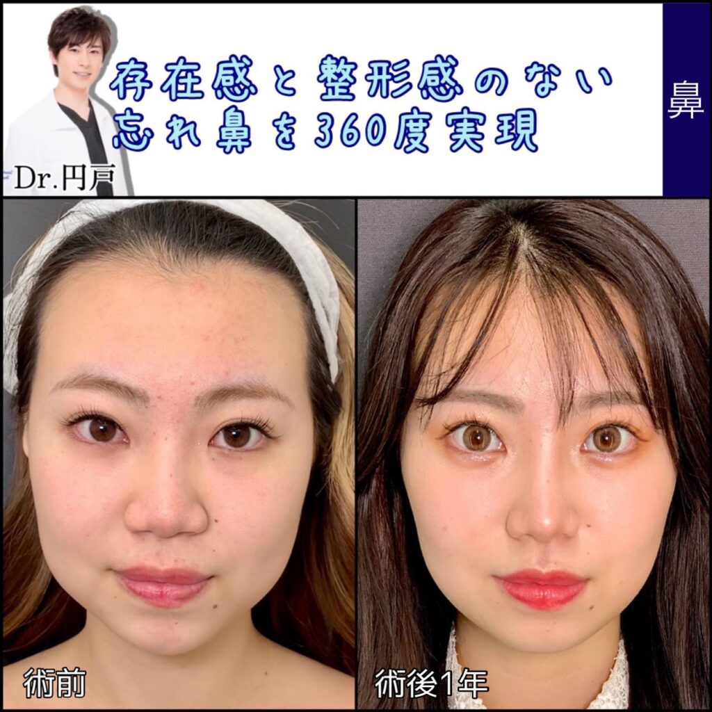 鼻尖形成と軟骨移植と鼻中隔延長と法令線基部人口真皮と鼻背部軟骨以上と小鼻縮小の症例写真
