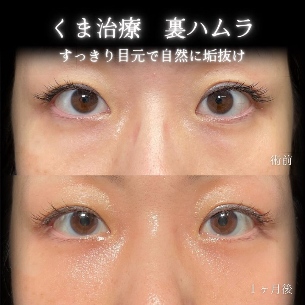 eクリニック横浜みあとみらい院の裏ハムラの症例画像（5）