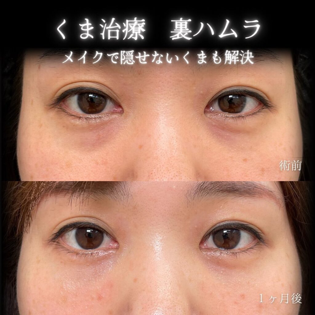 eクリニック横浜みあとみらい院の裏ハムラの症例画像（4）