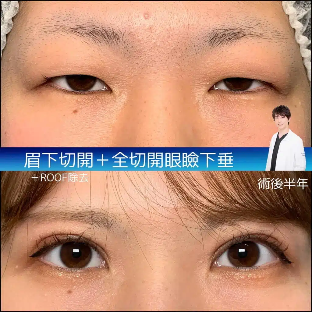 眉下切開　全切開眼瞼下垂　ROOF除去　横浜みなとみらい