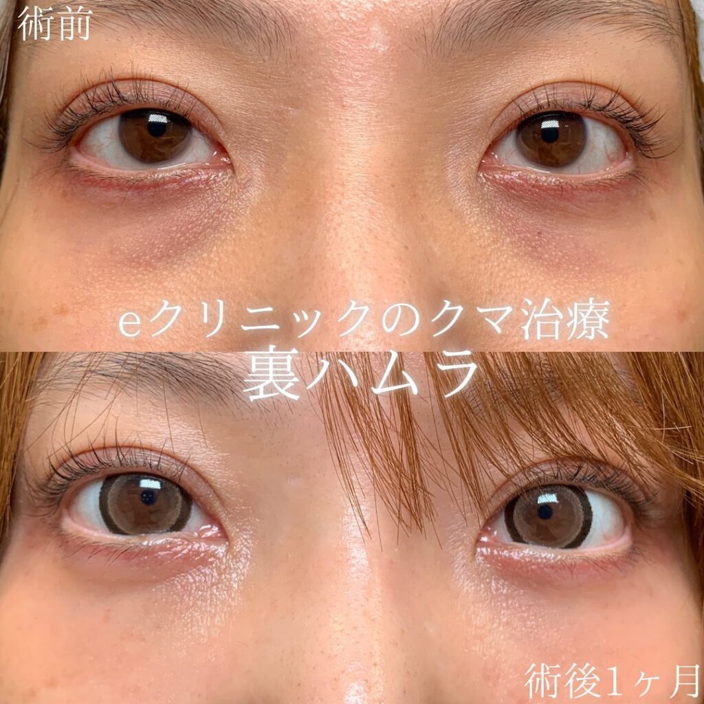 eクリニック横浜みあとみらい院の裏ハムラの症例画像（1）